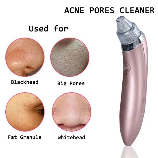5-in-1 Blackhead Vacuum Pore Cleaner & Acne Remover